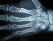 x-ray